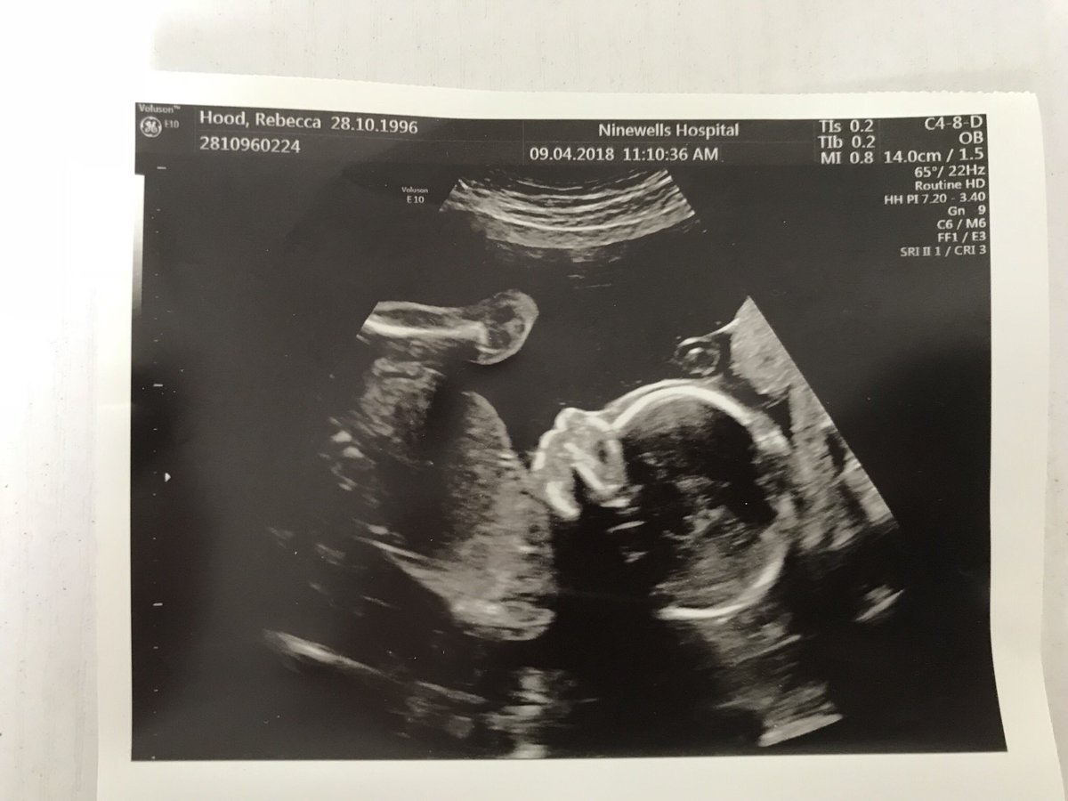 becca_hood's tweet image. My tiny wee baby- literally so much love can’t wait to meet her💗 #5weekstogo