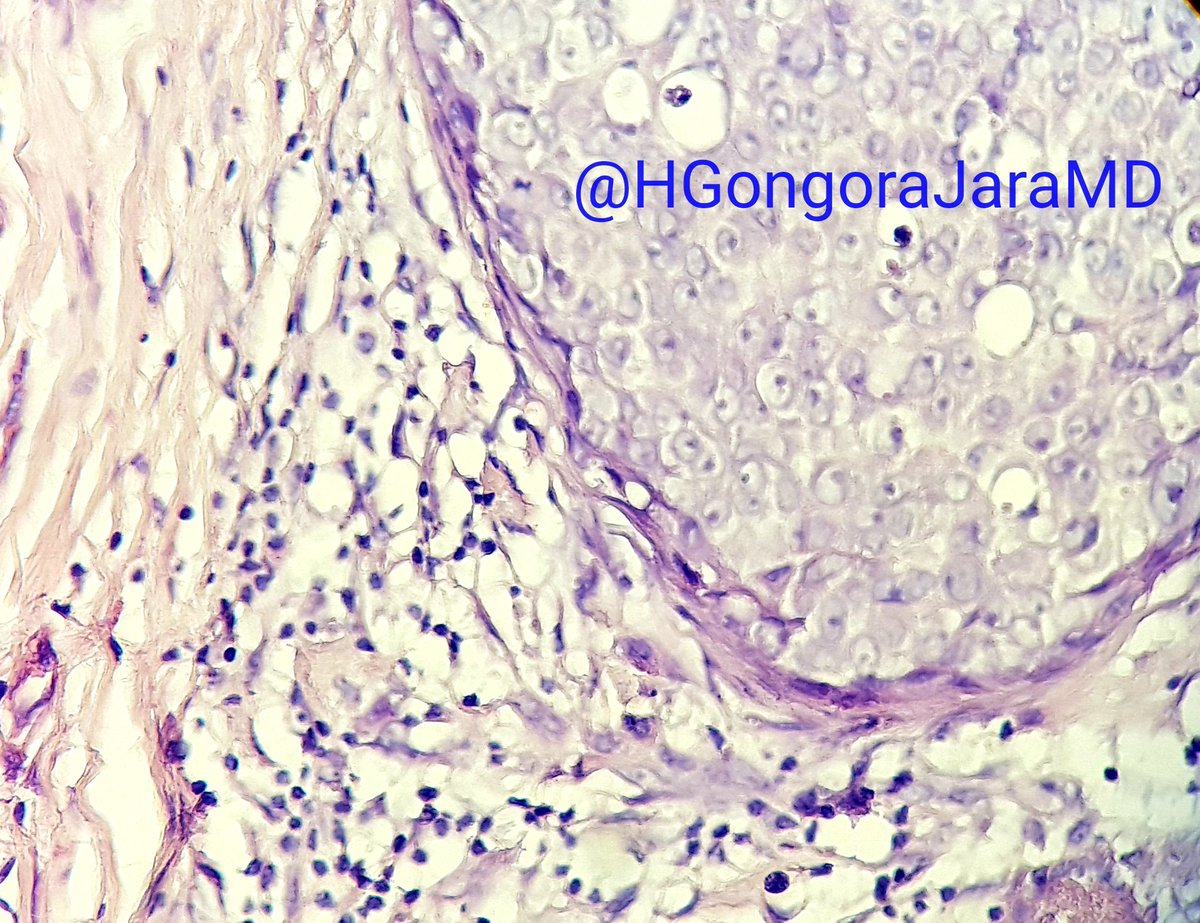 HGongoraJaraMD's tweet photo. Breast microinvasive carcinoma highligted by HER2/neu. On the left (HE) the cells could simulate myofibroblasts. #breastcancer #microinvasive https://t.co/FKizQ41LlH