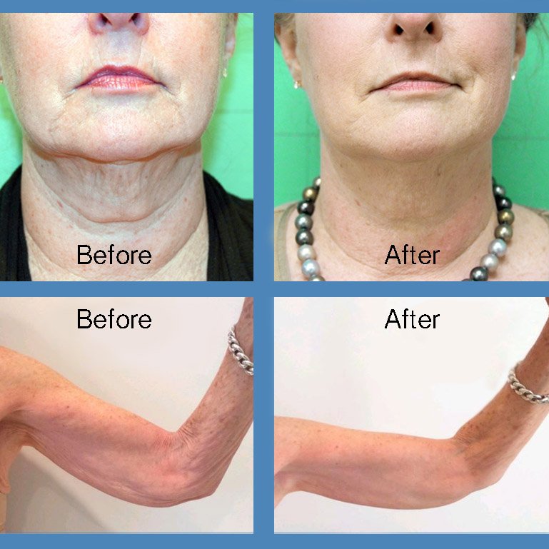 Before and after of the Protégé Elite treatment, a painless procedure that improves skin laxity. It can be used to tone and tighten sagging skin in the brows, lower face, jawline, neck, and body.

Book an appointment: unionderm.com/patient-portal…