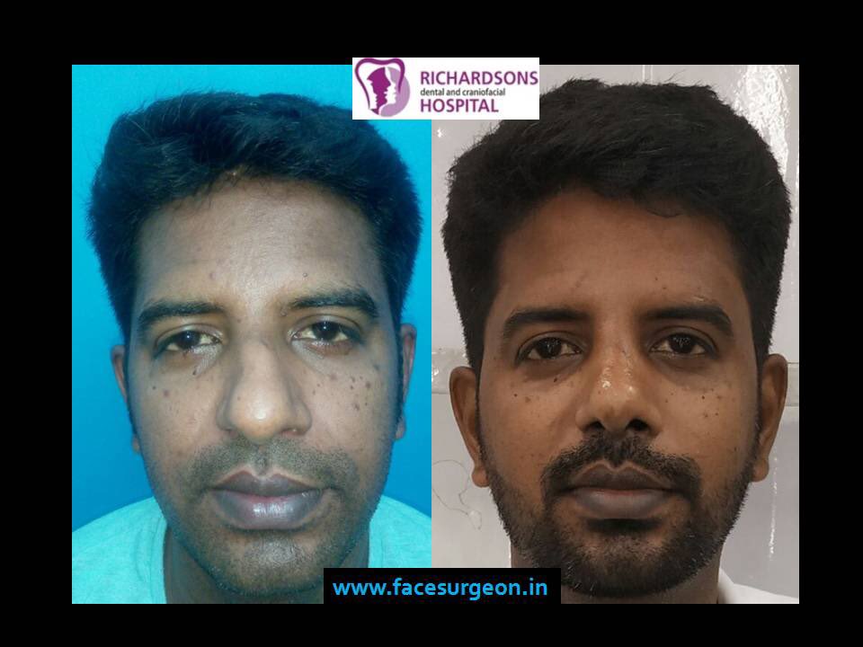 AndeiSoI's tweet photo. #Rhinoplasty - Before and After 

The bulbous tip was reduced, the bend in the dorsum corrected and the entire nose narrowed besides correcting his blocked #nose with a #septoplasty. 

#septorhinoplasty #nosesurgery #nosejob #nosecontouring #openrhinoplasty #openrp #closedrp https://t.co/yCU5x9dptY