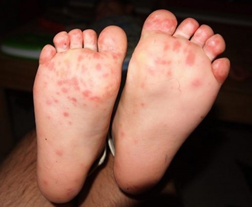 #медицина: Что приводит к герпесу на руках и ногах? опубликована на Pro-Herpes.ru - pro-herpes.ru/labialnyj-gerp…