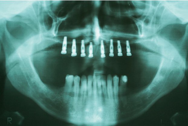 ncbi.nlm.nih.gov/m/pubmed/29426… #Osseointegrated #dentalimplants can be #usedsuccessfully in the #oralrehabilitation of #patientswithheadandneckcancer with a #historyofradiationtherapy.