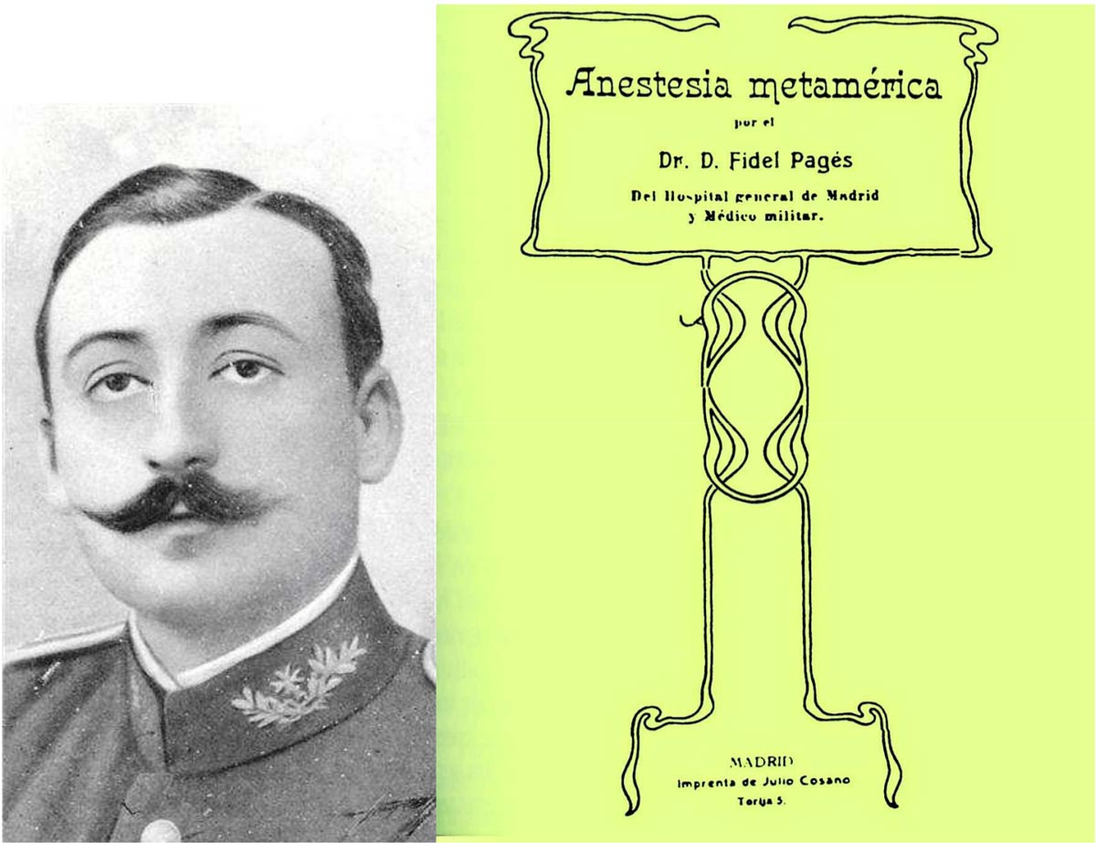 Fidel Pagés, médico militar, combatió en la Guerra de Melilla, donde su obsesión fue hallar un tipo de anestesia local para intervenciones quirúrgicas. Publicó su descubrimiento en 1921, dos años antes de morir. En el nº 237 (julio): ’Pagés, el olvidado inventor de la epidural’.