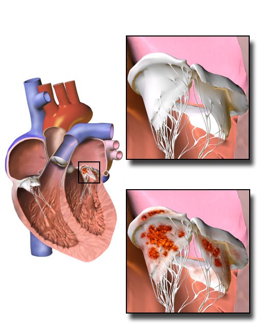 MedBiotechnol's tweet photo. #TetralogyofFallot #Mitralvalvestenosis #Endocarditis https://t.co/SszN260rrn