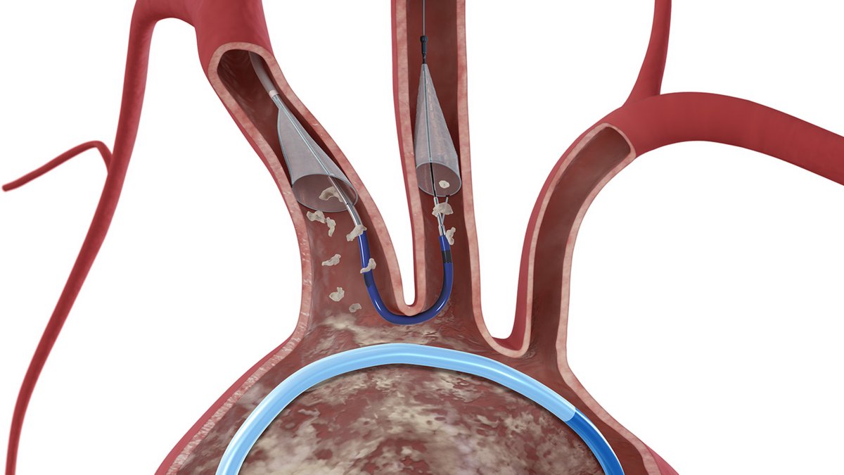 sierrracsmith's tweet photo. Great feature on @bostonsci's acquisition of @claret_medical, by @LizMedtech. "It was really an easy consideration for the organization to look at cerebral embolic protection, and within this context, Claret is [the] undisputed leader" https://t.co/3vCH3stWqZ #ProtectedTAVR #TAVR https://t.co/4Ib6iQixmd
