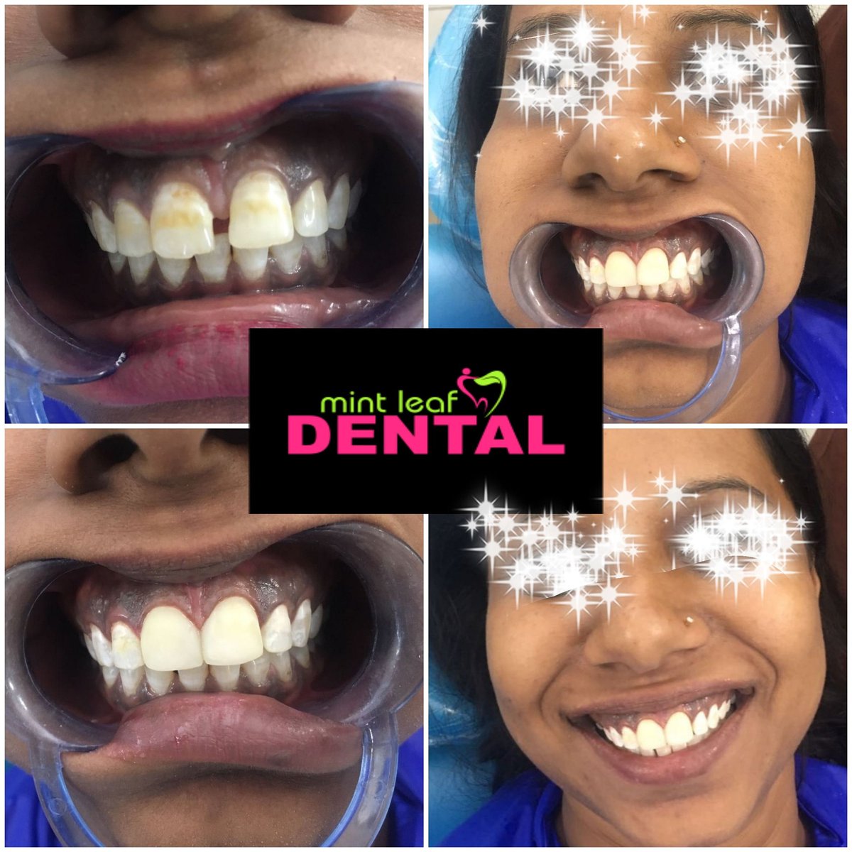 Mint Leaf Dental ) (DentalLeaf) Twitter