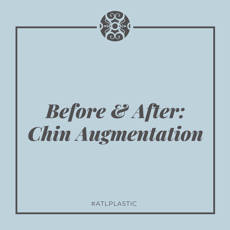 ATLcosmeticsurg's tweet photo. #ChinImplants can help enhance a small chin, establish a stronger, more proportionate chin and jawline or provide balance or proportion to the face. Swipe to see the before &amp; after of one of our chin augmentation procedures. #ATLPlastic https://t.co/Hdeyw5qGm3