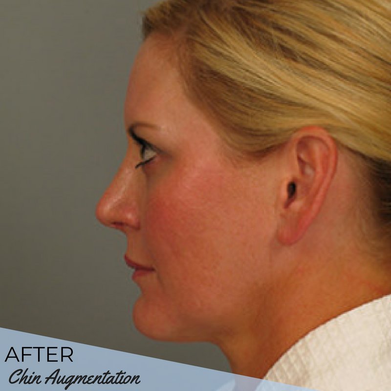 ATLcosmeticsurg's tweet photo. #ChinImplants can help enhance a small chin, establish a stronger, more proportionate chin and jawline or provide balance or proportion to the face. Swipe to see the before &amp; after of one of our chin augmentation procedures. #ATLPlastic https://t.co/Hdeyw5qGm3