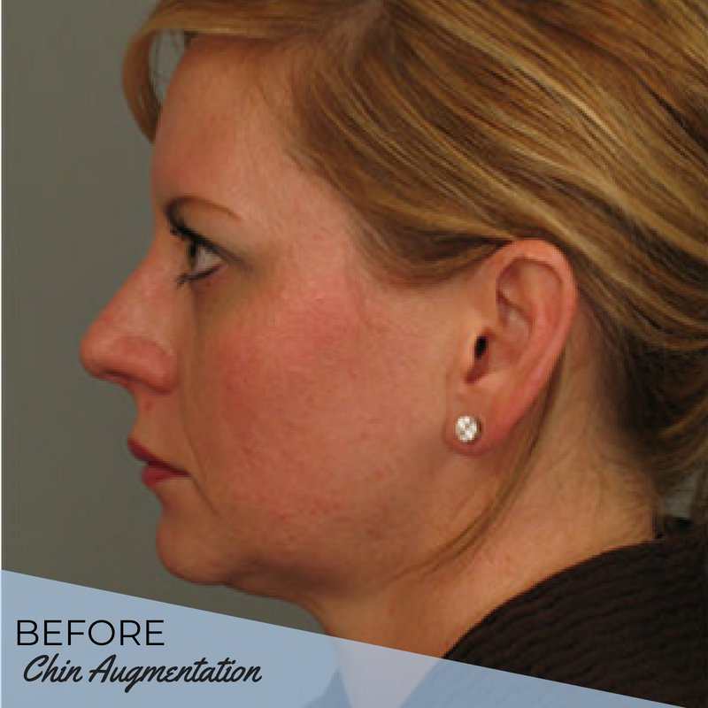 #ChinImplants can help enhance a small chin, establish a stronger, more proportionate chin and jawline or provide balance or proportion to the face. Swipe to see the before &amp; after of one of our chin augmentation procedures. #ATLPlastic