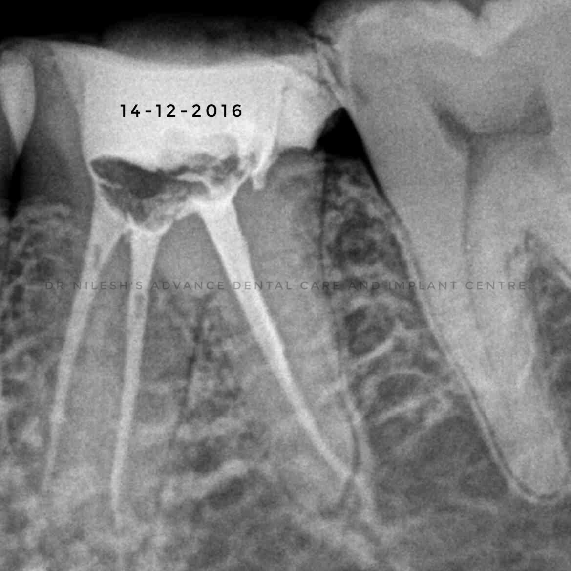 dndc_Pune's tweet photo. 20 Month Follow Up RCT 19 (Universal Numbering System) Case.
RCT done 20 Month back.,
Apex locator finding show 3mm less than Radiograpic Apex in MesioBuccal Canal.
Crown placed after core Build by Amalgam. https://t.co/9cpth1dhRz