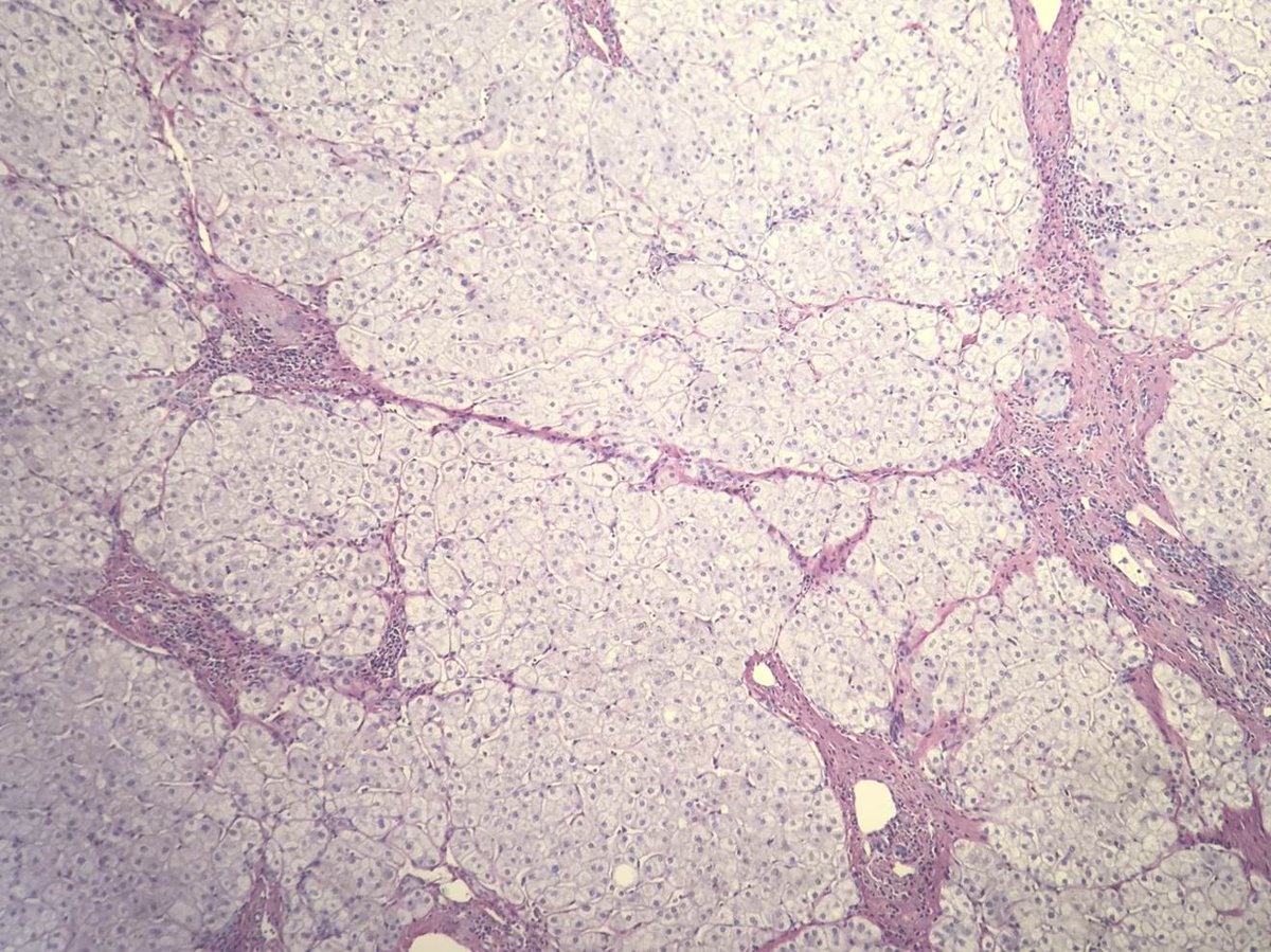 2cAnapath's tweet photo. Prélèvement hépatique effectué chez un patient infecté par le virus de l'hépatite C. Coloration de rouge Sirius, X100. https://t.co/IWkLRRKE2i