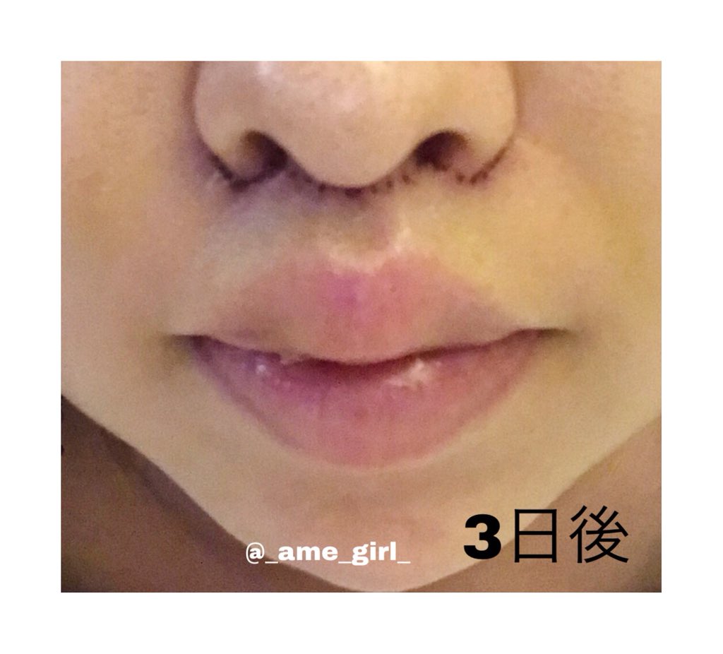 人中短縮 上口唇短縮 18 8 Twitter 人中短縮 上口唇短縮 18 8 Twitter