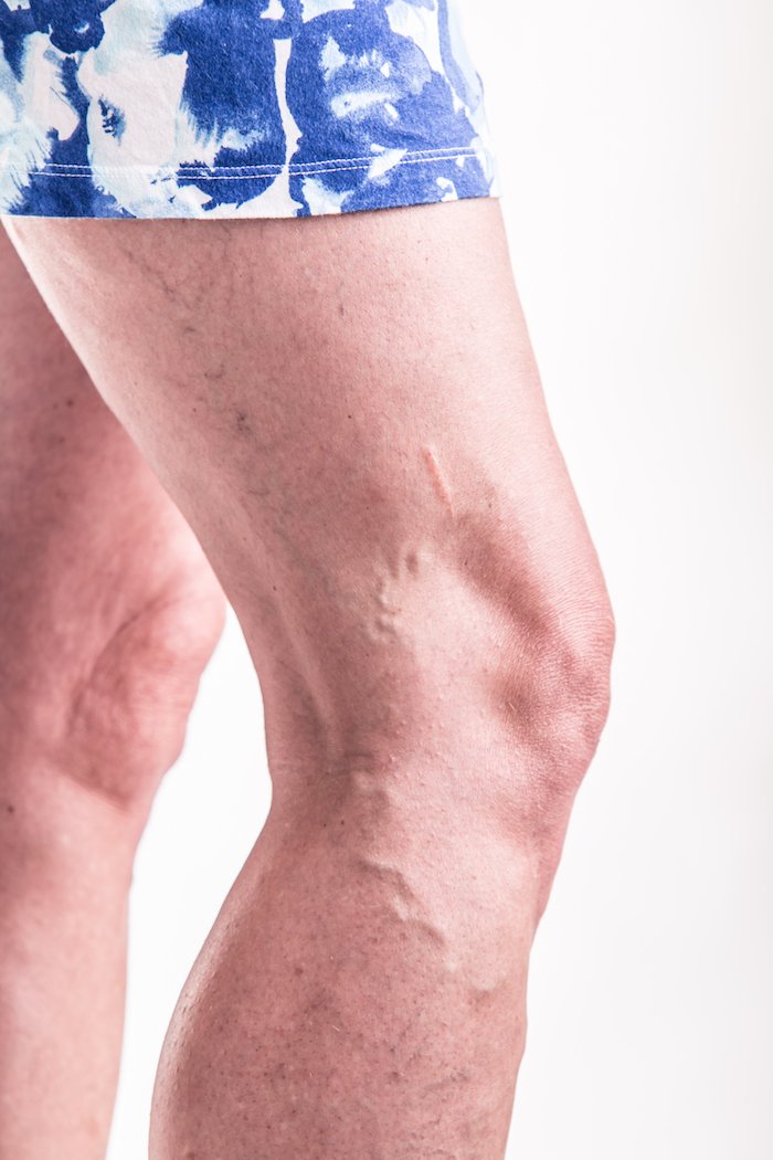 PremierDerma's tweet photo. Varicose Vein Relief 
(https://t.co/bfh4jtDSHt)

#boyntonbeach #doctor #varicoseveins https://t.co/ELqNdeA968