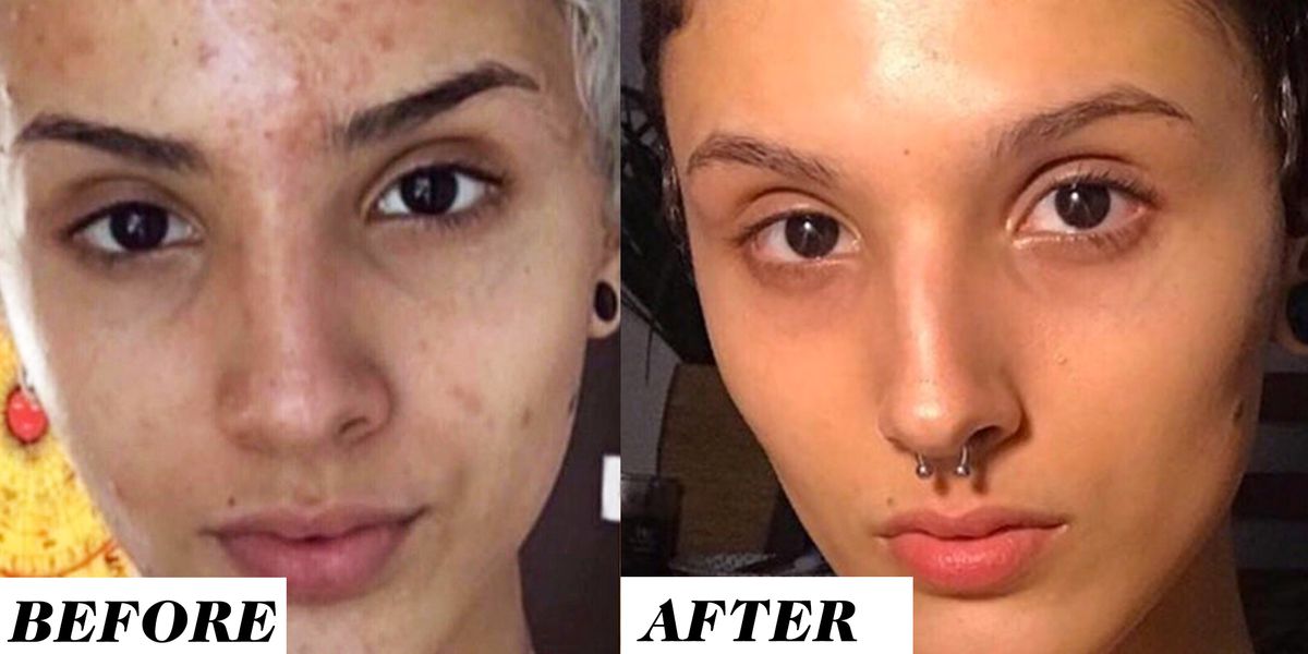 marieclaire's tweet photo. This Before-and-After Retinol Photo Is Going Viral on Reddit https://t.co/cGxdPaaFtB https://t.co/zyDsbXgVy5