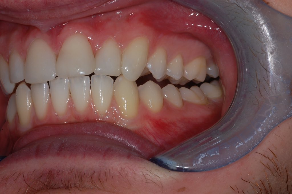 Nick Daily-Hunt (@nickd_h) on Twitter photo Nice #diastema closure and tidy-up today using @VOCOuk Amaris. No tooth preparation, completely adjustable, one visit. Aesthetic #dentistry as it should be - no downsides! Available <a href="/AlbertPlace/">Adam Noble</a> #congleton #cheshire #happypatient <a href="/moodyterrace/">Rachael Dodd</a> <a href="/VOCOAmerica/">VOCO America Inc</a> Nice #diastema closure and tidy-up today using @VOCOuk Amaris. No tooth preparation, completely adjustable, one visit. Aesthetic #dentistry as it should be - no downsides! Available <a href="/AlbertPlace/">Adam Noble</a> #congleton #cheshire #happypatient <a href="/moodyterrace/">Rachael Dodd</a> <a href="/VOCOAmerica/">VOCO America Inc</a>