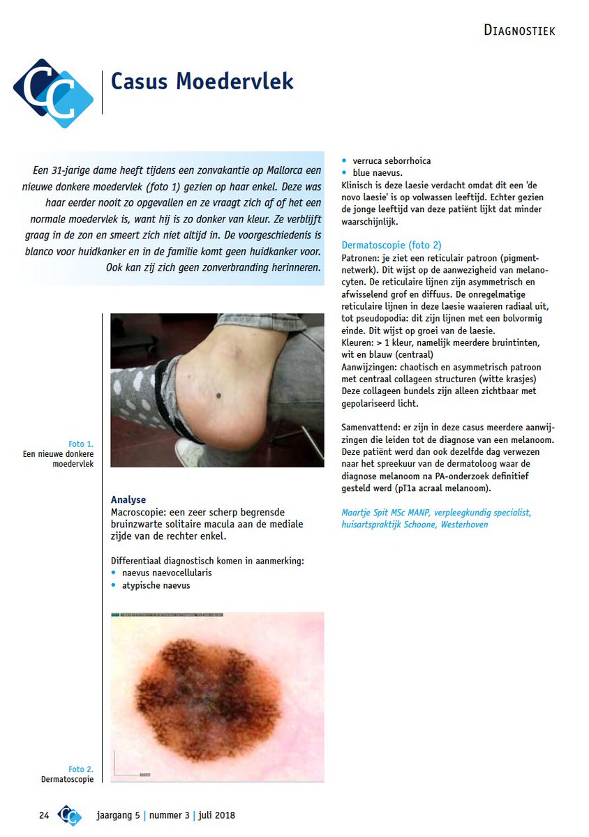 Voor #cutiscura juli schreef <a href="/MaartjeSpit/">maartje spit</a> een prachtige casus over dermatoscopie. Ook op de hoogte blijven van deze diagnostiek? Via dermatoscopie.nl kun je abonneren op een nieuwsbrief.