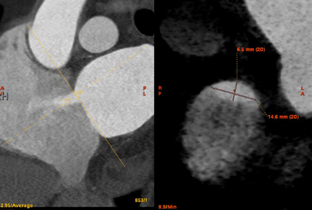 Cardiac CT ASD size and shape (MinIP cross sectional projection). See color rendering of same ASD on previous tweet.@Heart_SCCT #CardioTwitter #CCTA