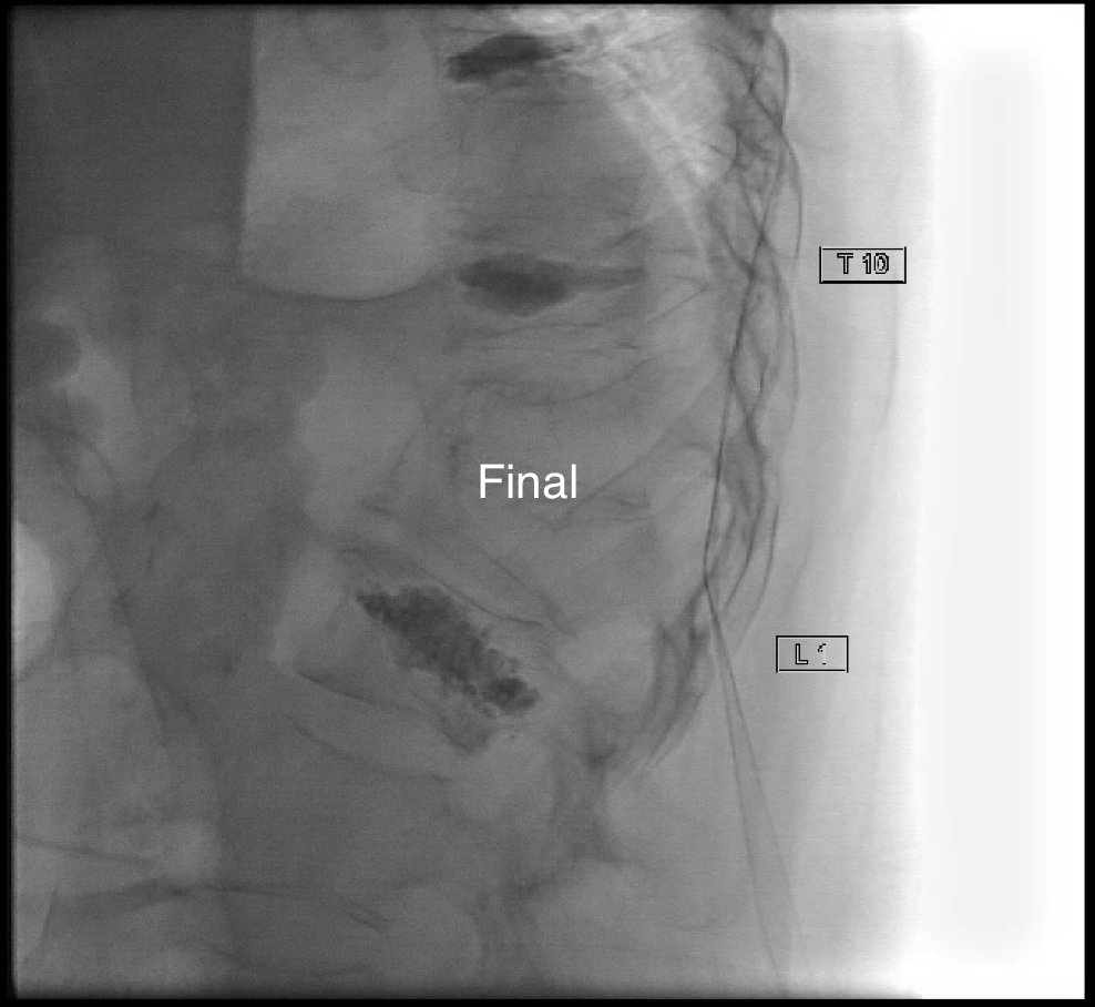 GuthrieIR (@guthrie_ir) on Twitter photo <a href="/guthrie_ir/">GuthrieIR</a> #irad @SarelGaurMD performs a 2-level <a href="/Medtronic/">Medtronic</a> #kyphoplasty @Guthrieclinic
#radiology
<a href="/SimaBanerjeeMD/">Sima Banerjee</a>
<a href="/joeirad/">Joe Ronsivalle</a> <a href="/guthrie_ir/">GuthrieIR</a> #irad @SarelGaurMD performs a 2-level <a href="/Medtronic/">Medtronic</a> #kyphoplasty @Guthrieclinic
#radiology
<a href="/SimaBanerjeeMD/">Sima Banerjee</a>
<a href="/joeirad/">Joe Ronsivalle</a>