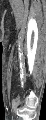 AndyBaadh's tweet photo. 55M w/ ESRD, non healing L heel ulcer, CTO of the mid SFA. Diffuse arterial &amp; venous calcification precludes bypass. Failed antegrade crossing with Outback and retrograde w/ crossing cath &amp; kissing balloon technique. Any ideas on how to cross the rock? #CLIFighters #StopTheChop https://t.co/ogPY43oxFp