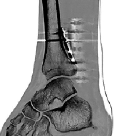 BoneJointJ's tweet image. The #posterior #malleolus #component of a #fracture of the #ankle is important, yet often overlooked; #surgeons believe there is considerable #merit in fixing most posterior malleolus fractures ow.ly/8l8d30l7r97 #ThrowbackThursday #ThursdayThoughts