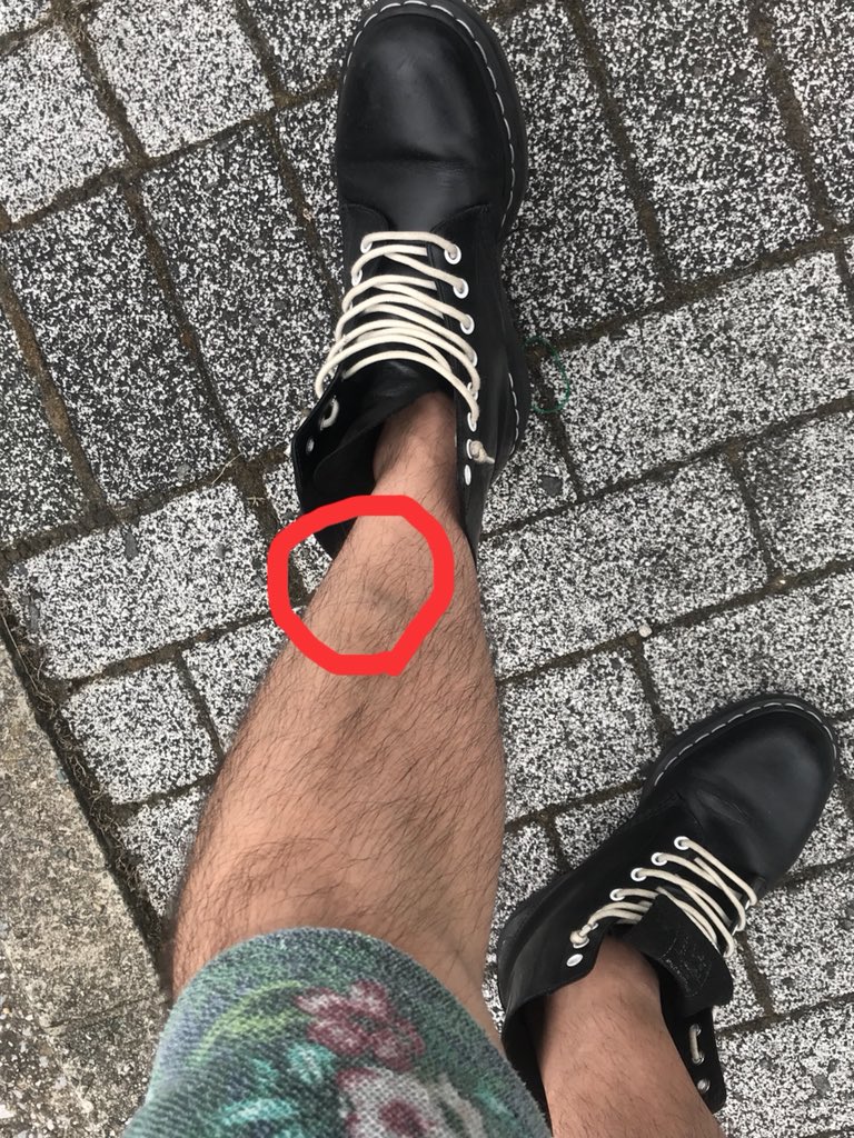 こまてぃん スネをどこかでぶつけた模様 全く記憶ないがドクドク脈打ってるのが中々痛い スネを打ってるのに記憶ないってもう末期だろ こまてぃん スネをどこかでぶつけた模様 全く記憶ないがドクドク脈打ってるのが中々痛い スネを打ってるのに記憶ないってもう末期だろ