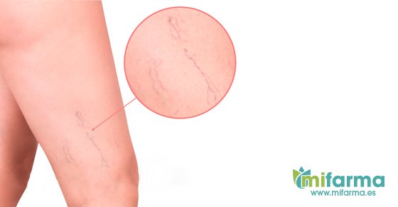 atida_mifarma's tweet photo. 👗¿Tapas tus piernas en verano, por las antiestéticas arañas vasculares?
En #Mifarma te contamos como prevenirlas! 😀
¿Te ayudamos? 👉🏻 https://t.co/KdFmk59QyV
...
#mifarmamemima #salud #piernas #arañasvasculares #novarices #pontefalda https://t.co/45SSET1xQ5
