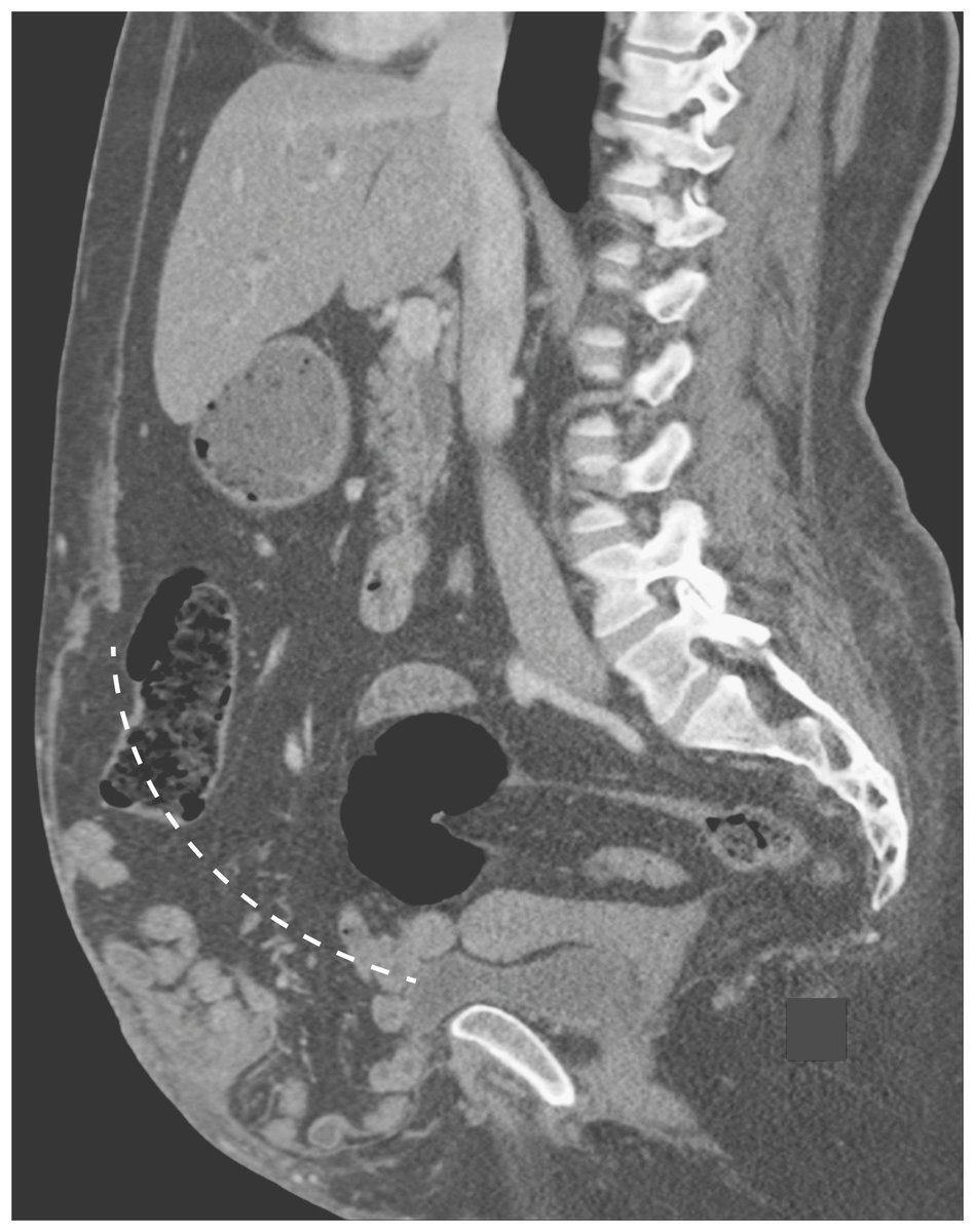 Medicine and Society: Surgical Gatekeeping — Modifiable Risk Factors and Ethical Decision Making nej.md/2LCGDNd