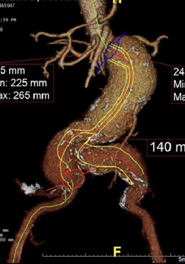 DrAliAzizzadeh's tweet photo. #juxtarenal #aortic #AAA and #iliac #aneurysms treated with #fenestrated and iliac #branched devices #minimallyinvasive #vascularsurgery @CedarsSinai https://t.co/HntugeHy9T