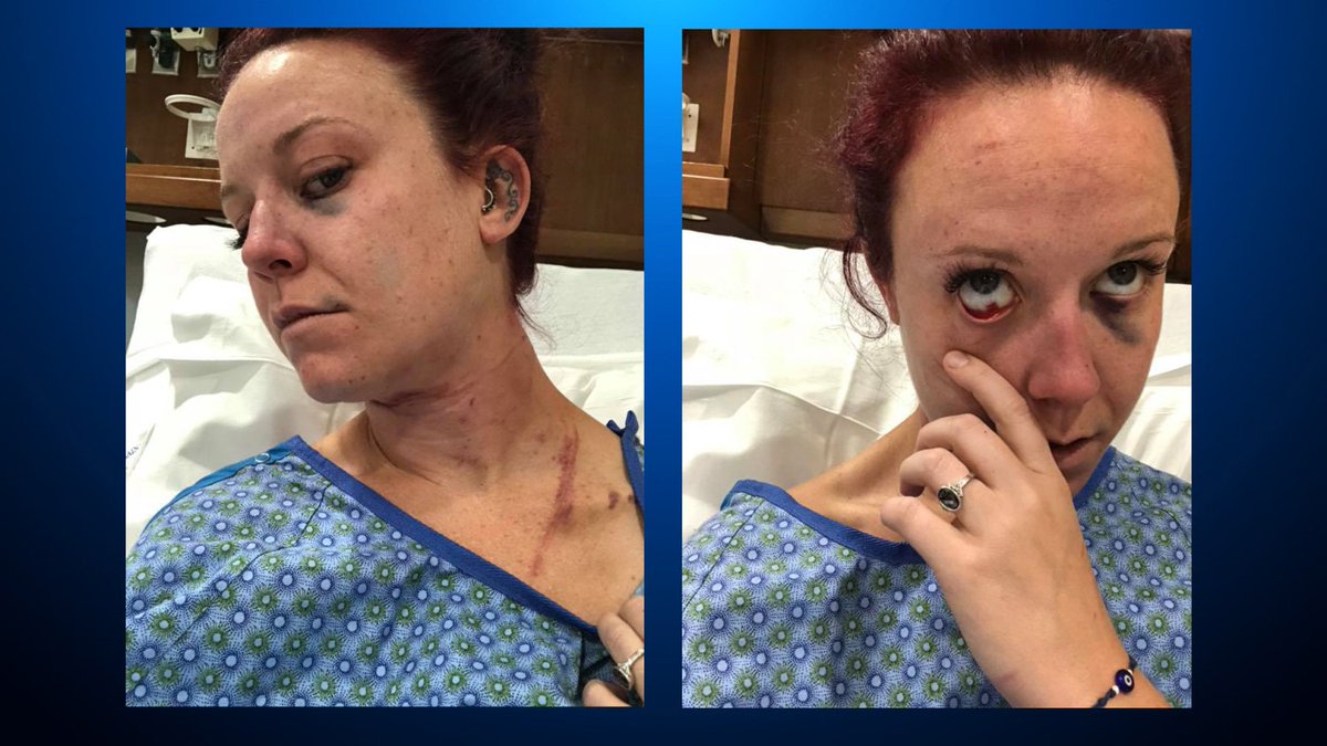 CBSNewsColorado's tweet photo. ‘I Fought Like Hell’: Woman Posts Photos After Violent Attack On Trail https://t.co/uusYL6ZMP8 https://t.co/c9cSi9VxIK
