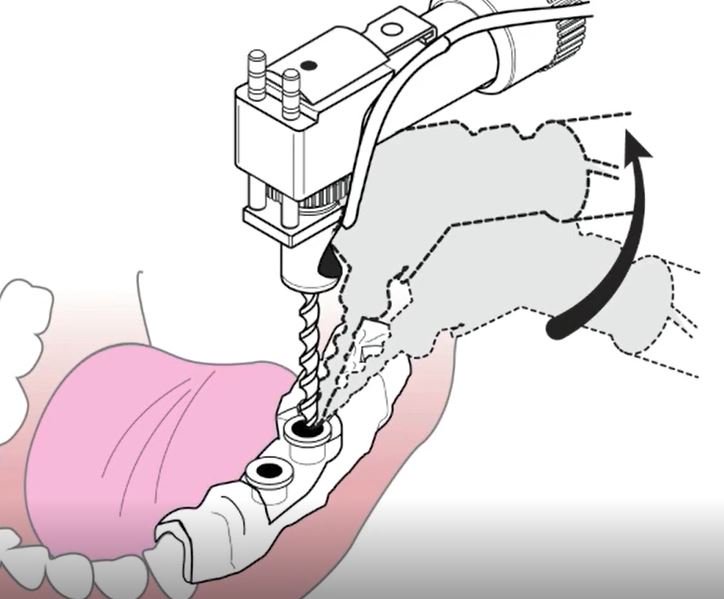 RestoreSurgical's tweet image. Ariston Dental has introduced an easy 4 step plan to ensure the most optimal GUIDED implant placement - even in difficult cases!   
Contact us to learn more or get involved as a Digital Ambassador 
#guidedsurgery  #implantdentistry #implantexperts