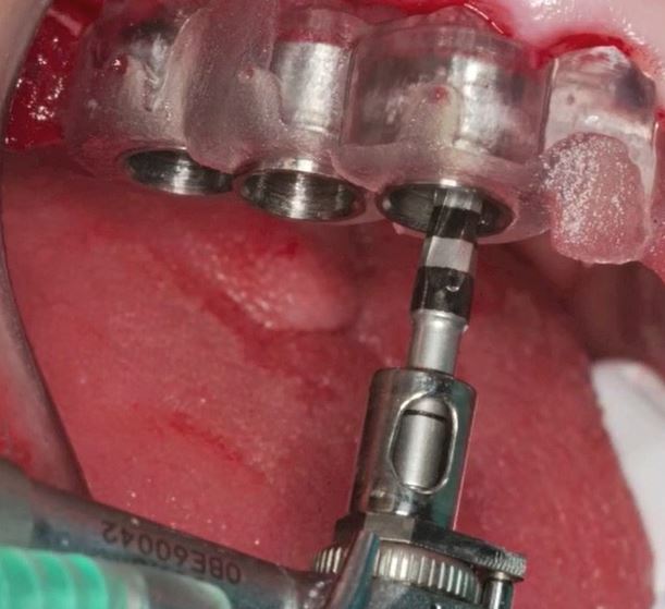 RestoreSurgical's tweet image. Ariston Dental has introduced an easy 4 step plan to ensure the most optimal GUIDED implant placement - even in difficult cases!   
Contact us to learn more or get involved as a Digital Ambassador 
#guidedsurgery  #implantdentistry #implantexperts