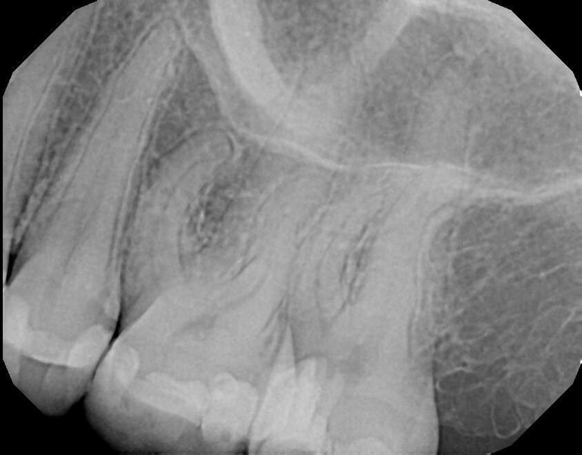 DrRicoShort's tweet photo. The SHORT Case Of The Day!
Tooth #15 Very Long Palatal Root
Patient came in pain & felt like it was a sinus issue. It was actually a tooth issue. Endodontic treatment was performed on tooth #15 in one visit using Brasseler USA NEW #ScoutFiles 🚀
#RootCanalsRock #EndodontistsRock https://t.co/4R09ecGw3e