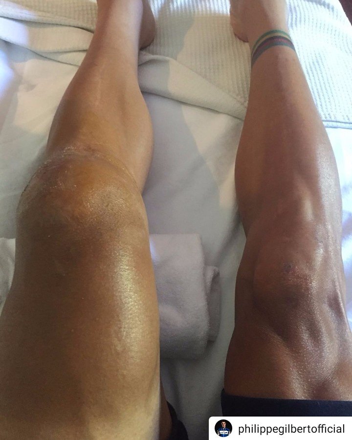 So this is what a patella fracture looks like. Kudos to <a href="/PhilippeGilbert/">Philippe Gilbert</a> for cycling another 60km in the <a href="/LeTour/">Tour de France™</a> after his crash. All the best in your recovery!