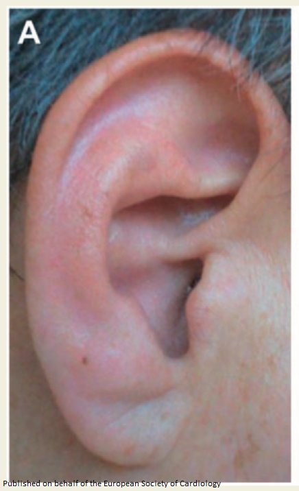 ESC_Journals's tweet photo. Frank’s sign: diagonal earlobe crease https://t.co/wkBzBHMeB3

@escardio #ESCCoT #CardioEd #CardioTwitter #freeaccess https://t.co/iXHUQzVsXe
