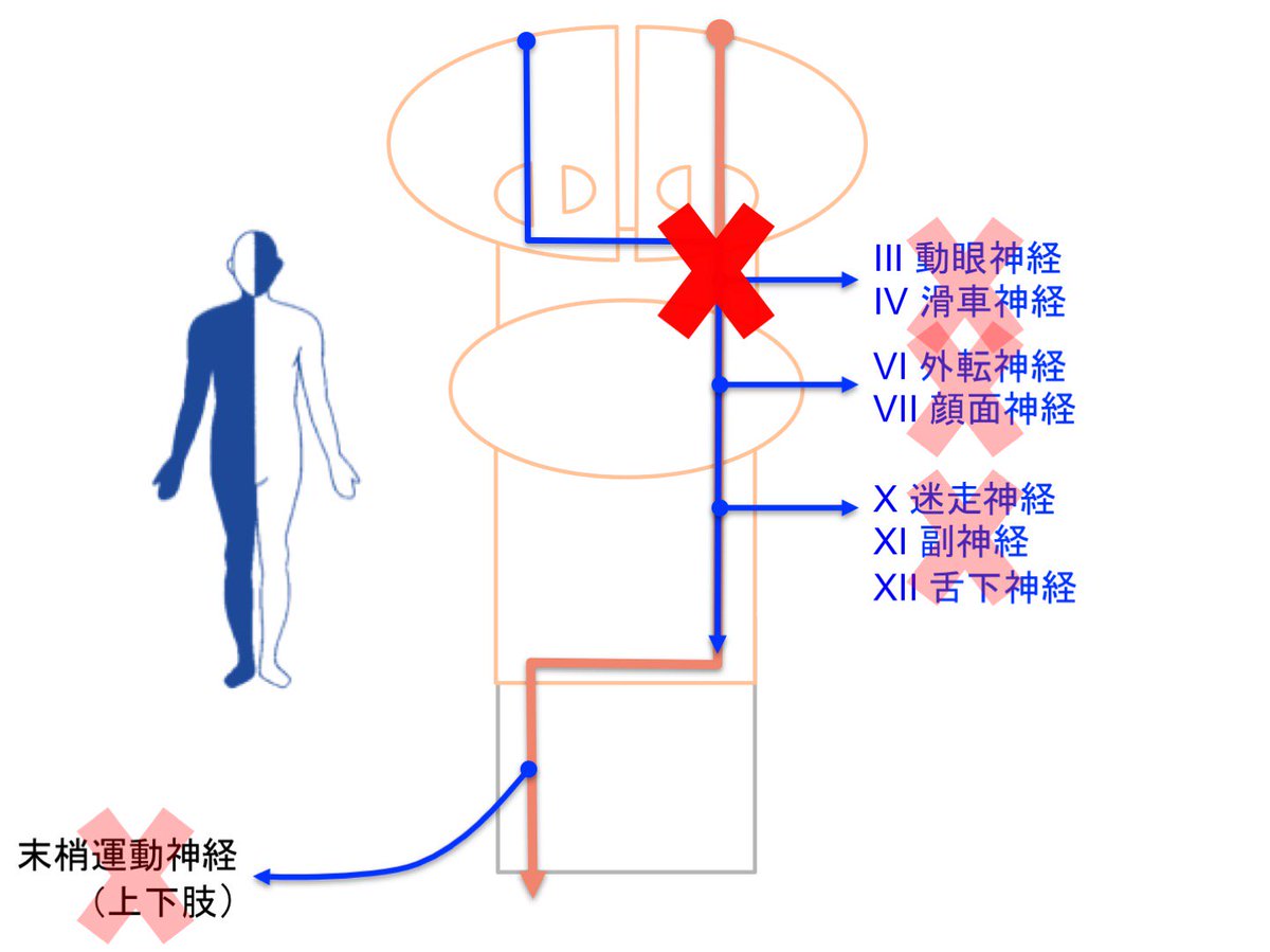 Oj Na Tviteru 麻痺 交叉性片麻痺1 脳幹片側に病変がある場合は 交叉性片麻痺 反対側の上下肢片麻痺と患側の脳神経麻痺 を生じます 中脳に病変がある場合は 動眼神経麻痺および顔面神経麻痺を生じるため 交叉性片麻痺がとてもわかりやすいです ウェーバー