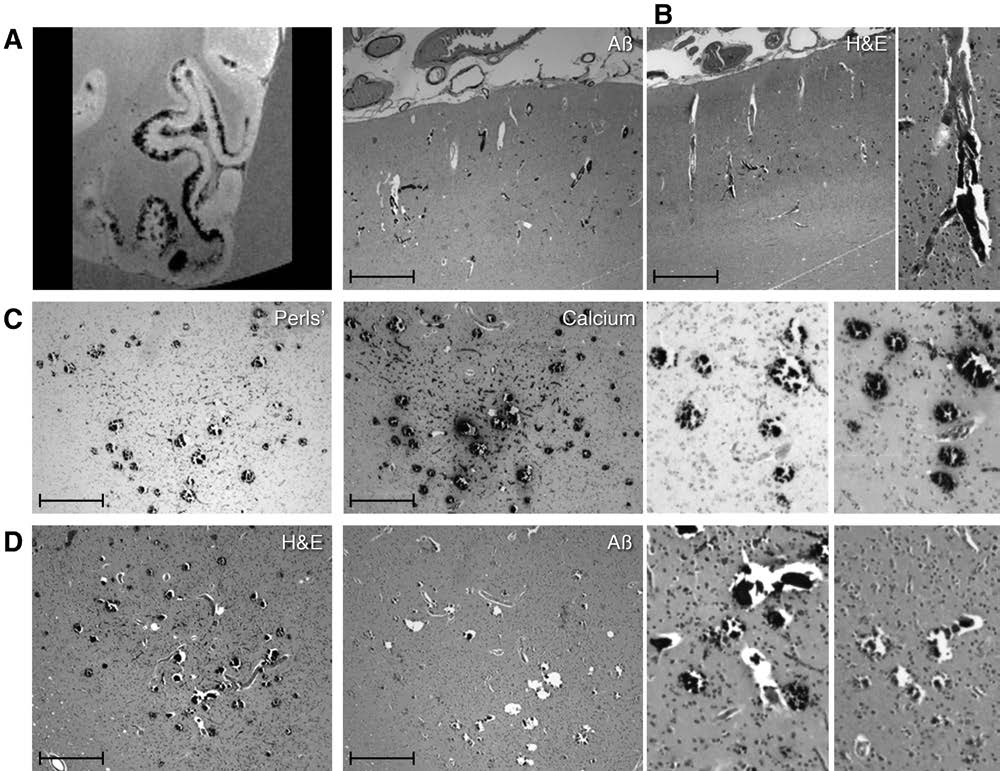 Cerebral Amyloid Angiopathy With Vascular Iron Accumulation and Calcification: A High-Resolution #MRI Histopathology Study #stroke ow.ly/j8Wo30l82CM