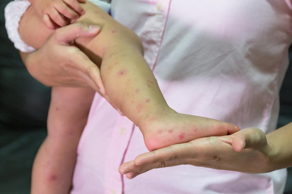 Hfmd rash