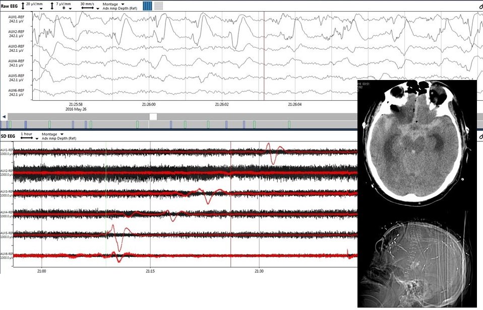 COSBID's tweet image. What do #spreadingdepolarizations look like after #SAH? Here&apos;s a great example using an ECoG strip electrode in a HH4 mF4 #SAH #neurocritical #FOAMed