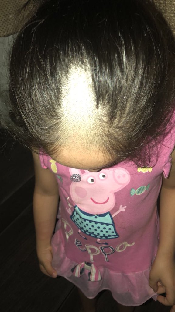 jerrshernandez's tweet photo. Mi sobrina se rapó, literal. No se qué vayan a hacer... Ósea la van a rapar toda? La van a dejar así mocha?
Gorras todo el año? Le van a poner extensiones de microchip? NO SE PERO NO MAMES JAJAJAJAJAJAJAJAJAJAJAJAJAJA (Perdón Diosito) https://t.co/F0WtBx1ViE