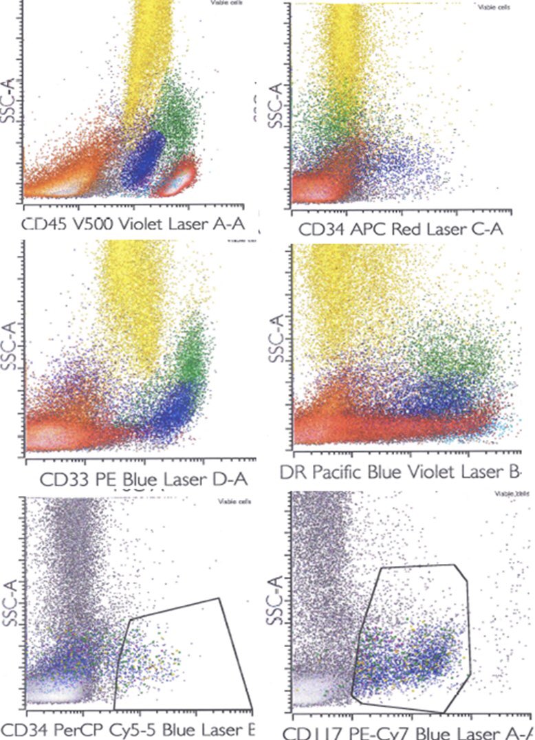 SueEPig's tweet photo. CD34(negative) AML is highly associated with t(15;17), similar to APML; CD117 expression in leukemic blasts remains unclear #hhpath #hemepath #cuplikeblasts #flowcyometry #learningflow https://t.co/INhLkt94iQ