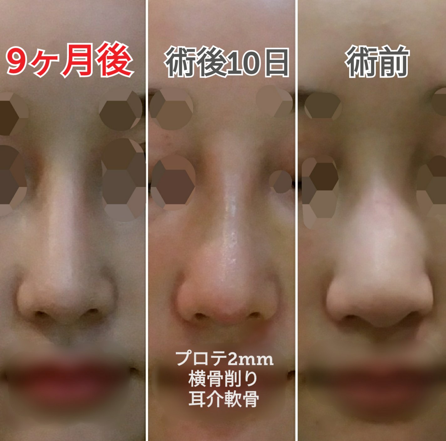 サラ 鼻の経過 術後から腫れとかあんまり気にしてなかったけど今思うと全然腫れてた しつこいけど鼻は一番分かりやすく顔が変わりました いい意味でも悪い意味でも一番印象が変わる部位だと思ってます T Co Yhz9dyhebb Twitter サラ 鼻の経過 術後から腫れとかあんまり気にしてなかったけど今思うと全然腫れてた しつこいけど鼻は一番分かりやすく顔が変わりました いい意味でも悪い意味でも一番印象が変わる部位だと思ってます T Co Yhz9dyhebb Twitter