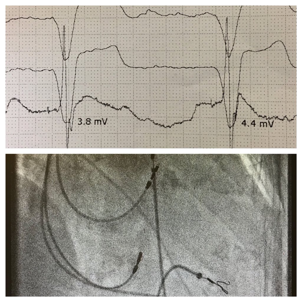 Pacer upgrade to HBP for pacing-induced cardiomyopathy. No sheath, just use curved stylet (medium). Extendable-retractable fixation (Biotronik Solia S). Did they say you can’t do that? #dontdisthehis #biotronik_US #biotronik_UK