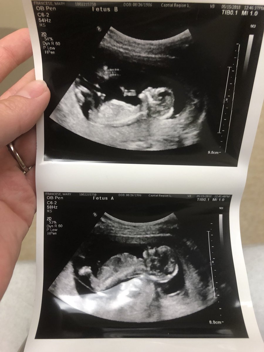 My Twin Angels, Harleigh Jane and Aria Rose, I will forever keep you close to me. ♥️ #TTTS #TTTSAwareness #raiseawareness #mybabygirls