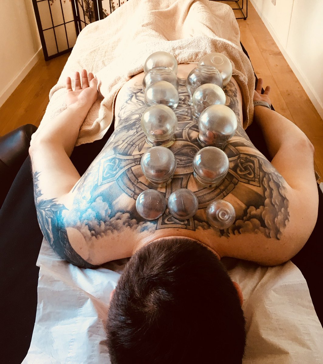 My Chinese Cupping Therapy coming to Maidstone soon 😀