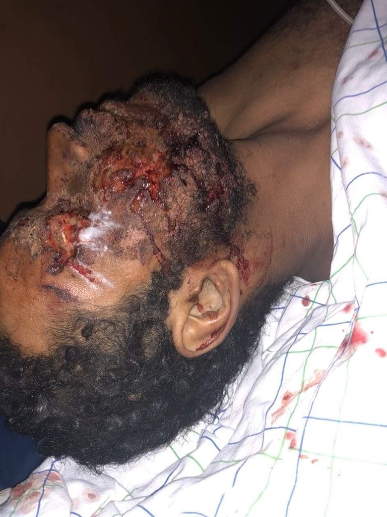 Rasd_TVOficial's tweet photo. Dos heridos 🤕 al explotar mina en Dchera, zonas ocupadas del #SaharaOccidental 🇪🇭
Las minas antipersonas diseminadas por el régimen marroquí 🇲🇦 siguen causando daños irreparables a la población civil saharaui. 
El territorio es uno de los más minados del mundo 🌍 7 millones https://t.co/zJrXgdISDX