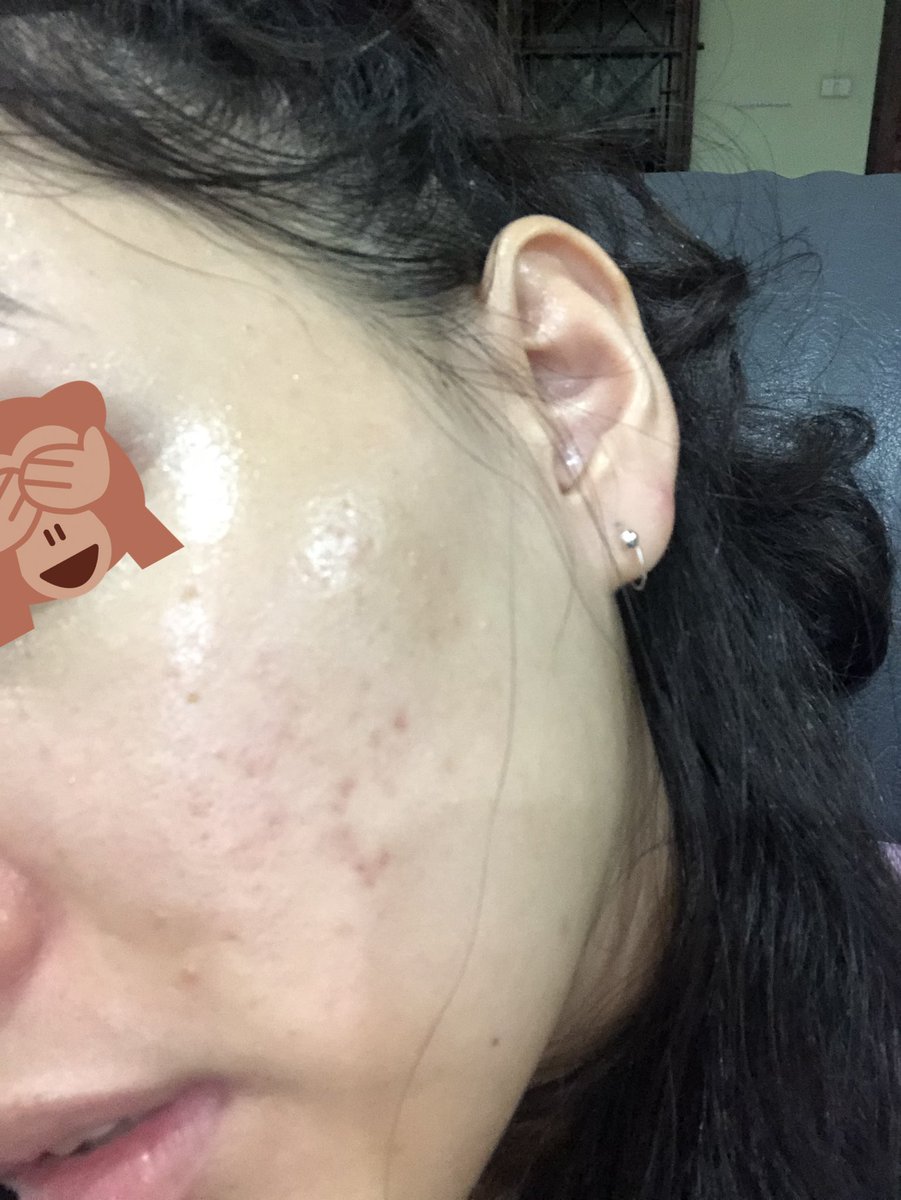 Kamon39007832's tweet photo. หลังจากที่ลองใช้ dragon’s blood 
2 รูปแรกคือ 1 เดือนที่แล้ว ที่เคยทวีตถามไปว่าจะใช้อะไรดี 2 รูปหลังคือภาพปัจจุบัน ถ่ายโดย I8+ ไม่ได้ผ่าน filterใดๆทั้งสิ้น #ไว้รีวิวห้ามขายของโว้ยย https://t.co/BWL5KazX69