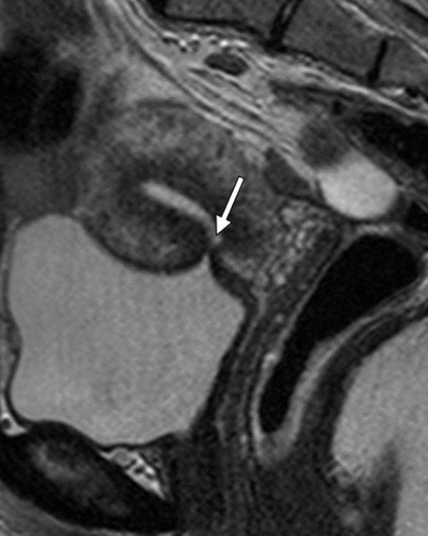 RadiologyArticl's tweet photo. #FoamRad #AbdRad #CesarianSection: Most viewed Radiology article on https://t.co/lZULG7Fkyr from 7/22/2018-7/218/2018: CT and MRI findings after Cesarean Section from DIR https://t.co/KxGXhucz4F https://t.co/7e0u5qw0O8