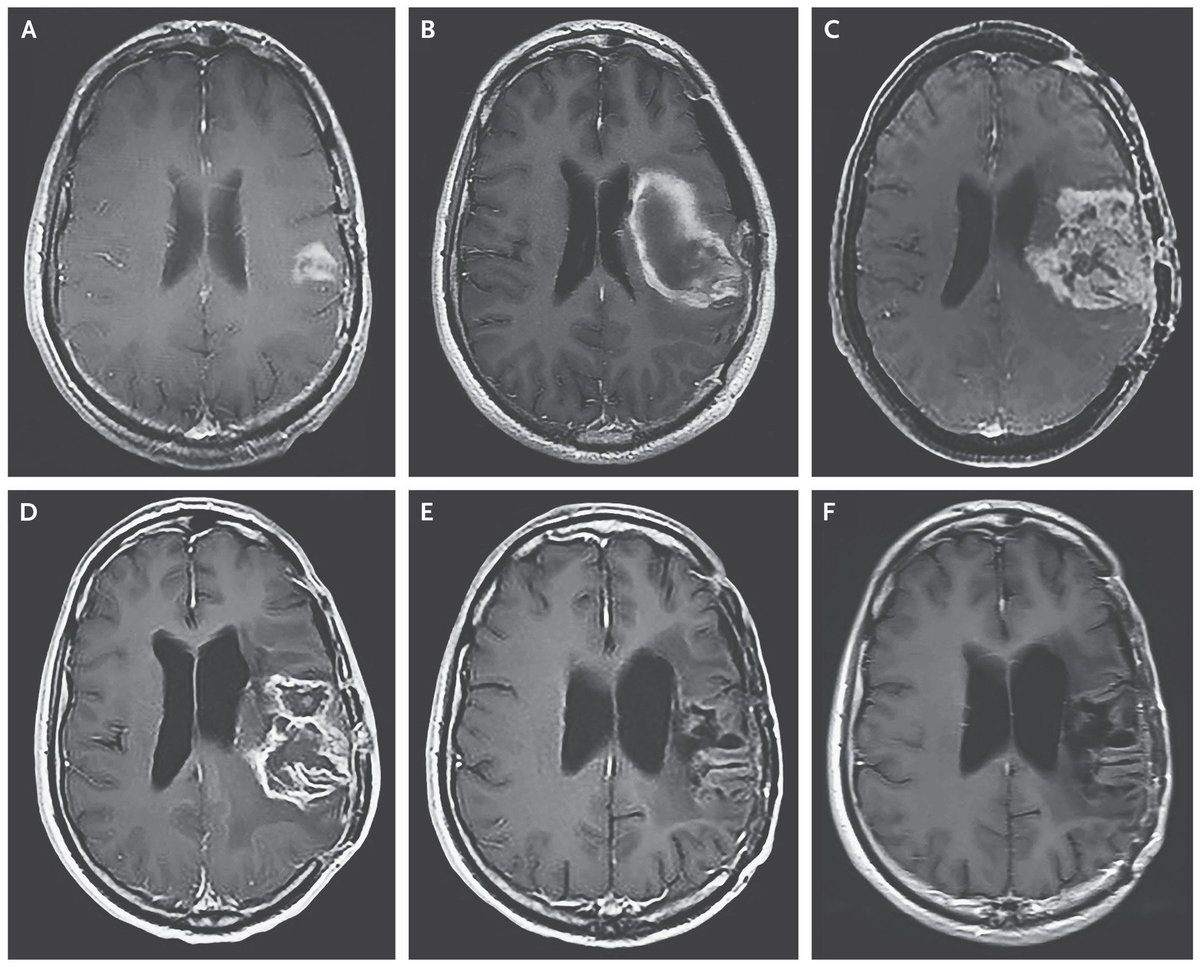 NEJM's tweet photo. Original Article: Recurrent Glioblastoma Treated with Recombinant Poliovirus https://t.co/KNq3KpjP5T #oncology https://t.co/R28KpZqmER