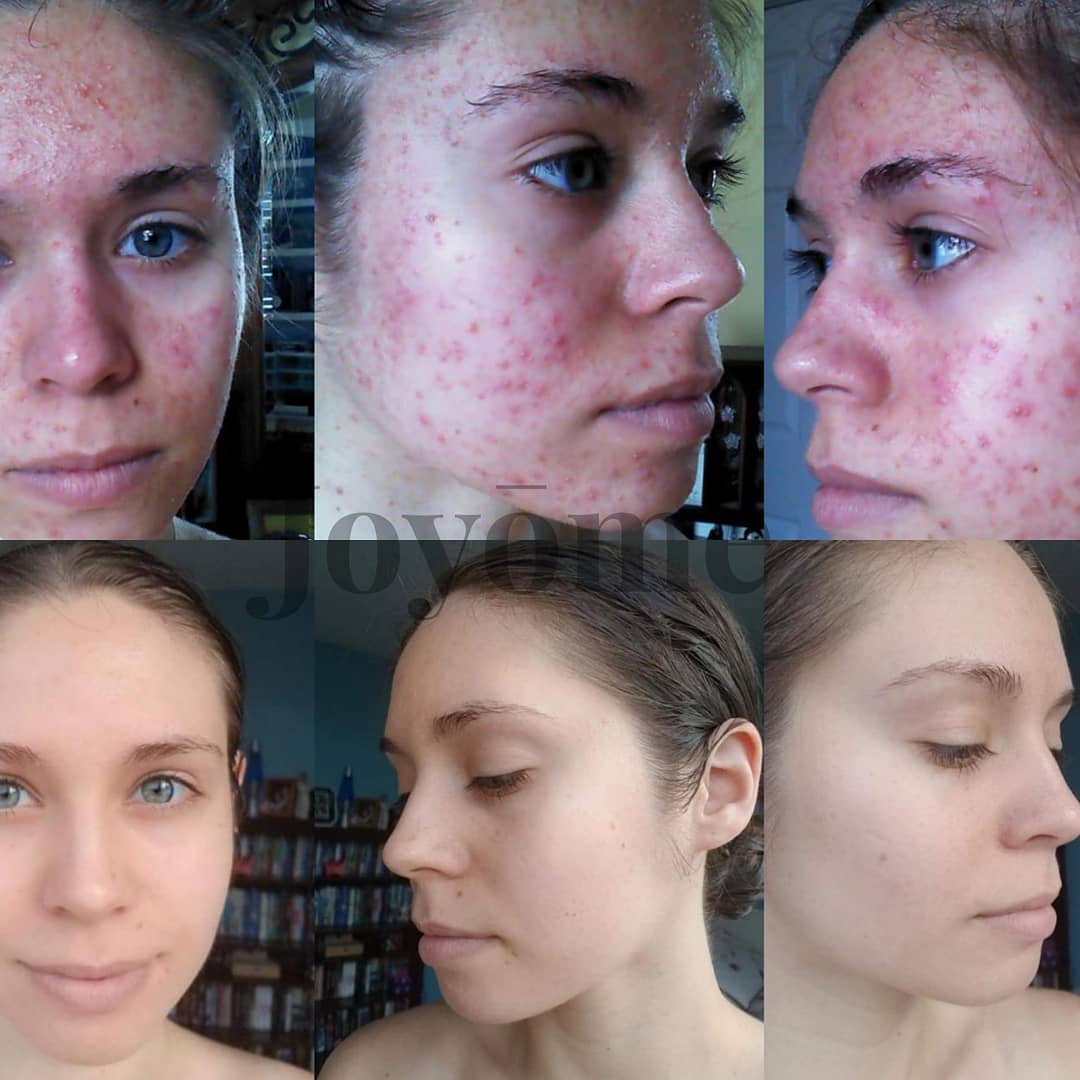 NikkiRhodes07's tweet photo. Loving this new #skincare and the #Results just keep coming in!!! #obsesh https://t.co/A0yrDSeHtk