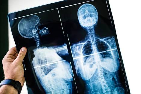 doctorneyro's tweet image. A current #challenge is the #patients’ view on #sideffects of the #treatments ón #osteoporosis— although they are very rare, the perception is high. healio.com/rheumatology/o…